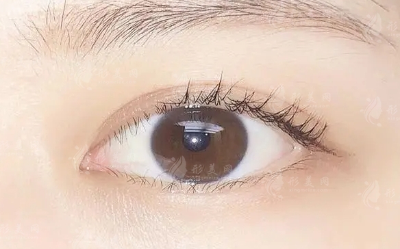 雙眼皮恢復(fù)時間與切開雙眼皮的腫脹影響因素
