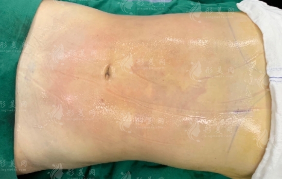 腰腹吸脂后多久開始瘦？要恢復(fù)多久？
