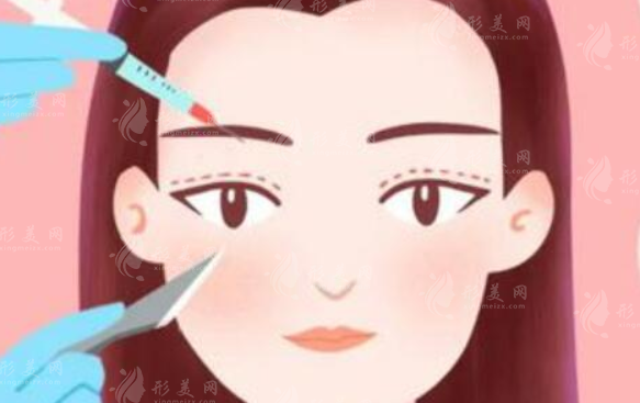 杭州美萊整形雙眼皮多少錢？醫(yī)生信息盤點，雙眼皮案例、價格表