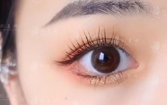 埋線雙眼皮維持多久？怎樣能加長維持時間？