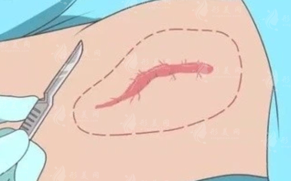 疤痕整形一般要多少錢？手術(shù)貴嗎？