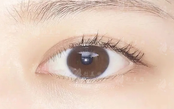 外眼角開大了可以矯正嗎？