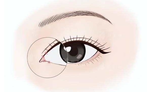 輕度內(nèi)眥贅皮的矯正與調(diào)節(jié)原則