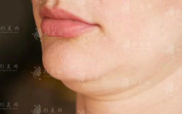 雙下巴抽脂頭套需要戴多久？