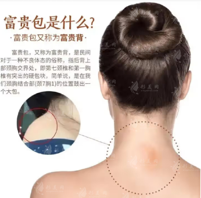 什么是富貴包？