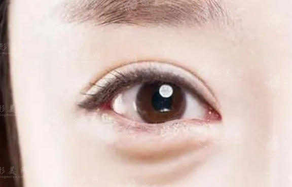 內切去眼袋多久恢復？快恢復的辦法是什么？