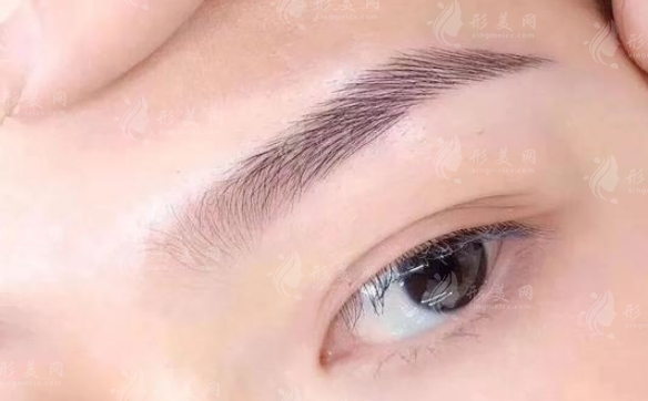 提眉手術(shù)：效果持久與消腫時間解析