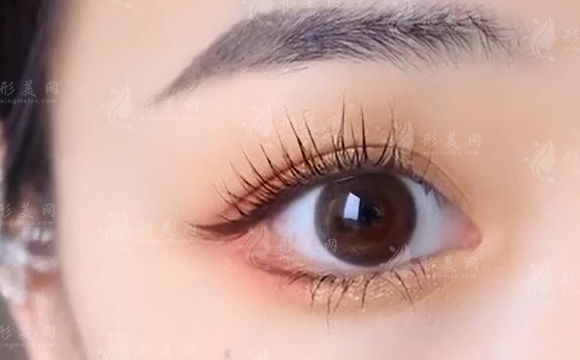 雙眼皮手術(shù)后出現(xiàn)浮腫怎么辦？常見消腫方法公開