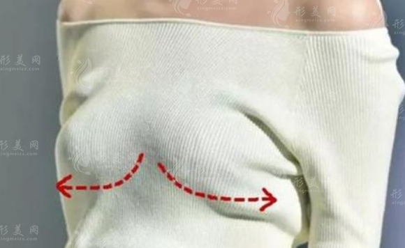 乳房下垂矯正的四種手術(shù)方法：你應(yīng)該選哪一種？
