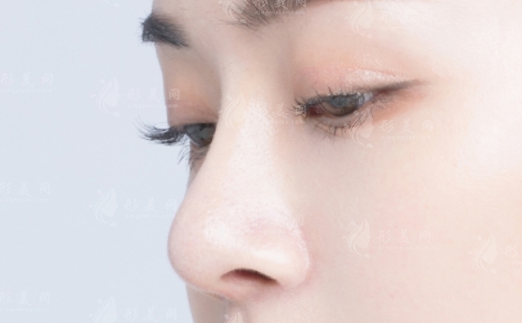 鼻翼外切后腫脹需要多長時(shí)間才能消退