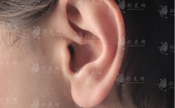 玻尿酸豐耳垂：安全性與栓塞風(fēng)險(xiǎn)探討