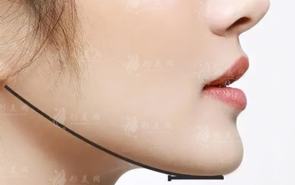 去除下頜角的方法及恢復時間