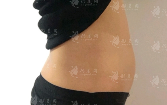 腰腹環(huán)吸會(huì)影響月經(jīng)嗎？及注意事項(xiàng)