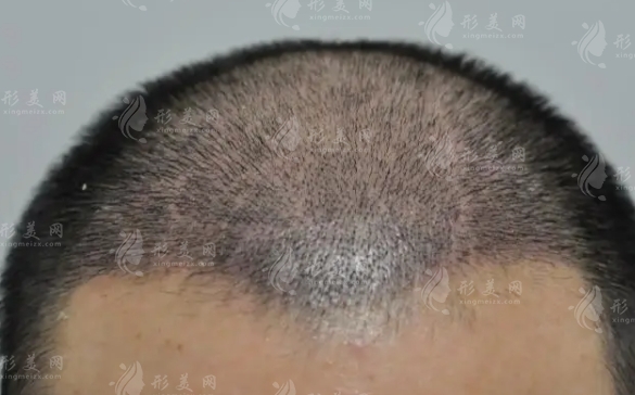 關(guān)于FUE植發(fā)：手術(shù)過程與注意事項全面解析