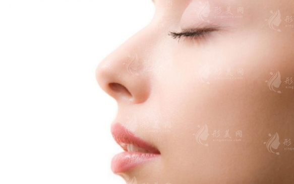 不用假體可以做鼻小柱延長嗎？怎么實現(xiàn)呢？
