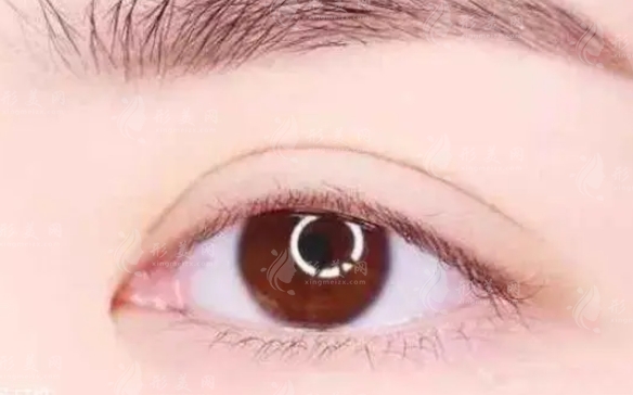 雙眼皮修復(fù)成功率高嗎？什么人適合做？