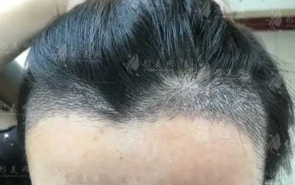 植發(fā)一次要取多少毛囊？微針植發(fā)技術(shù)詳解