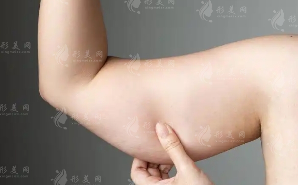 手臂吸脂：局麻與全麻的選擇及其風(fēng)險(xiǎn)探討