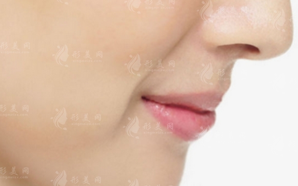 鼻唇溝微整形費(fèi)用及其影響因素