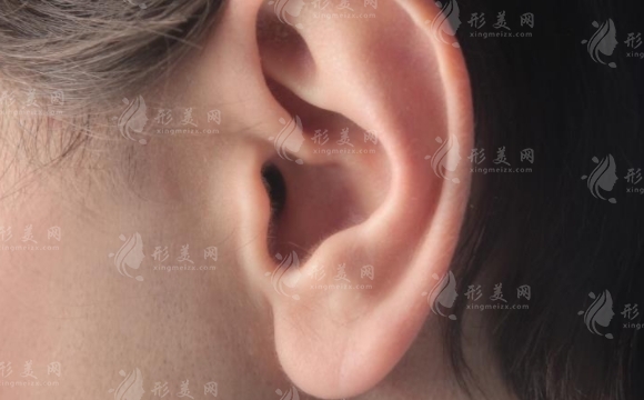 自體脂肪豐耳垂的缺陷及彌補(bǔ)方法