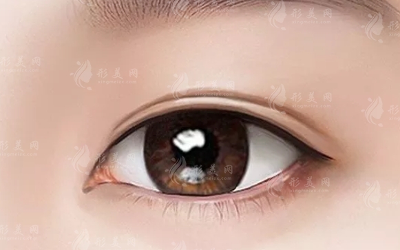 切開(kāi)法重瞼術(shù)：適用人群與長(zhǎng)期效果解析