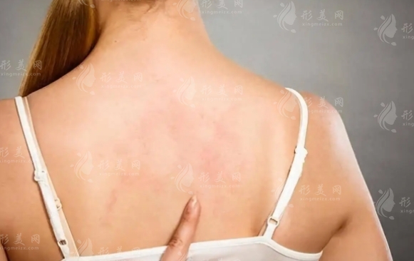 背部吸脂：常識、風(fēng)險(xiǎn)與并發(fā)癥