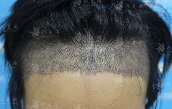 微針植發(fā)的優(yōu)勢與適應癥
