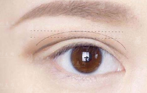 埋線雙眼皮：是否需要割開？答案因情況而異