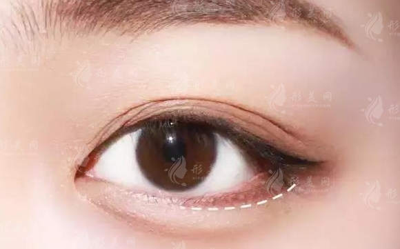 膠原蛋白豐臥蠶：消腫時(shí)間與材料副作用解析