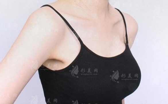 假體隆胸手術(shù)失敗修復(fù)難度高嗎？恢復(fù)時(shí)間長(zhǎng)不長(zhǎng)？