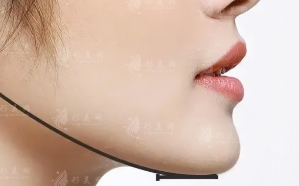 下頜角手術費用及術后注意事項
