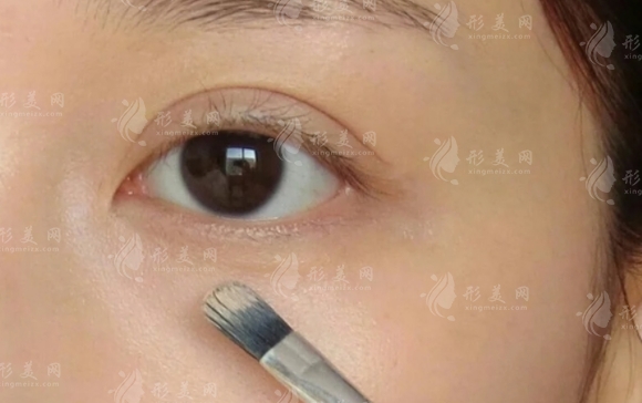 玻尿酸填淚溝好在哪里？原來不選擇自體脂肪是這個原因！