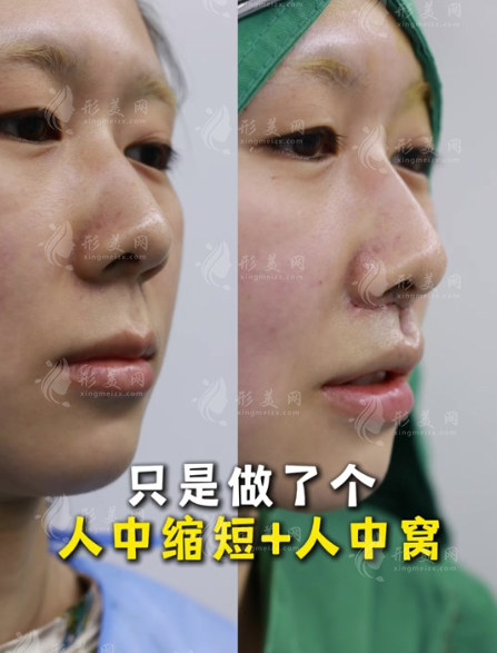 人中縮短術(shù)對比照片：明星都在悄悄做的減齡秘訣 