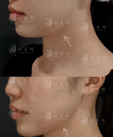 上海時(shí)光做下頜角靠譜嗎?技術(shù)價(jià)格醫(yī)生全解析