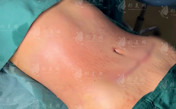 杭州腹壁成型術(shù)哪家好?五大醫(yī)院技術(shù)實力全揭秘