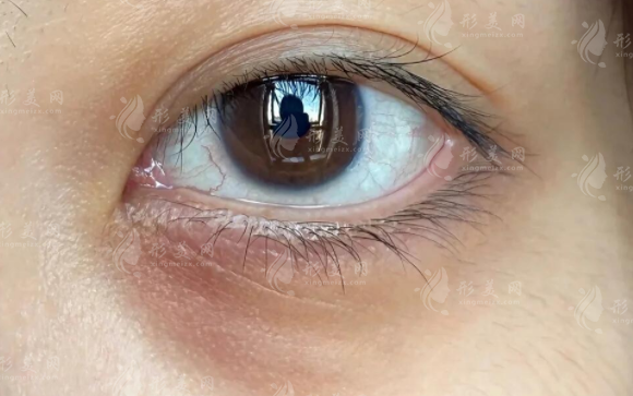 鄭州王劍做眼袋價格多少?技術(shù)怎么樣?一篇說清!