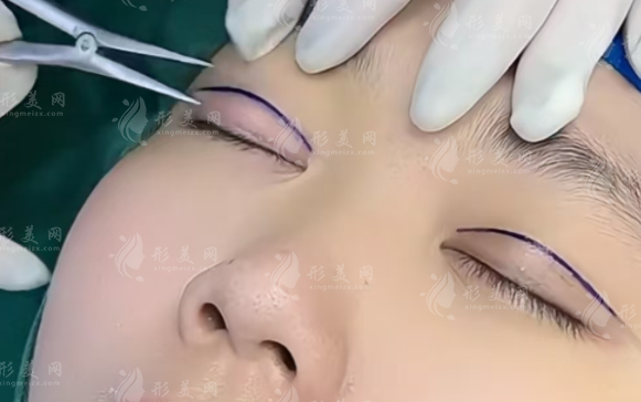 西安雙眼皮醫(yī)生哪家好?這6位專家技術(shù)口碑雙在線 西安雙眼皮醫(yī)生哪家好?這6位專家技術(shù)口碑雙在線