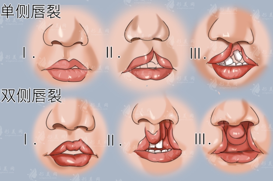 唇裂術(shù)后鼻孔不對稱怎么辦？鼻畸形修復(fù)術(shù)全攻略