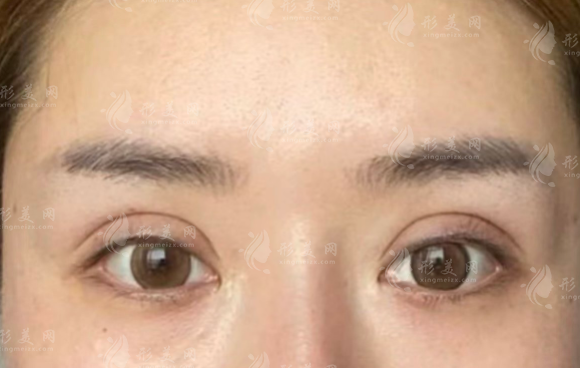 北京張冰潔眼修復(fù)技術(shù)可靠嗎?媽生感效果實(shí)測(cè)