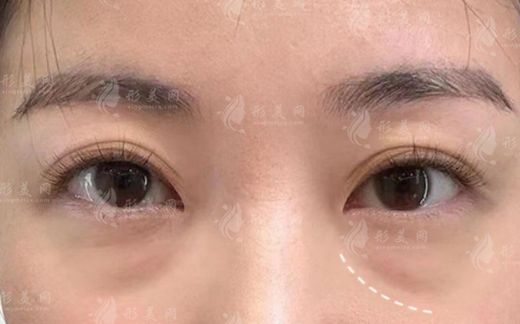 去眼袋580元靠譜嗎?低價眼袋手術真相揭秘