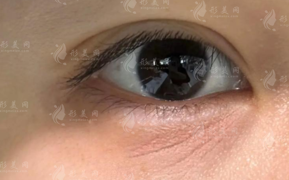 眼周注射膠原蛋白去細紋靠譜嗎？效果真相大揭秘