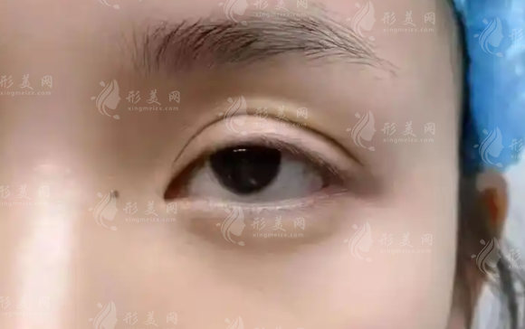 北京張冰潔眼修復(fù)口碑怎么樣?20年經(jīng)驗(yàn)+解剖復(fù)位技術(shù)解析