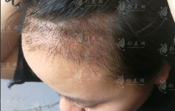 濟南植發(fā)醫(yī)院哪家好？海峽植發(fā)口碑實力揭秘