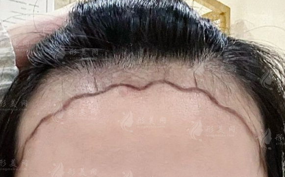 天津植發(fā)醫(yī)院哪家好?熙朵植發(fā)上榜前三技術(shù)價(jià)格全解析