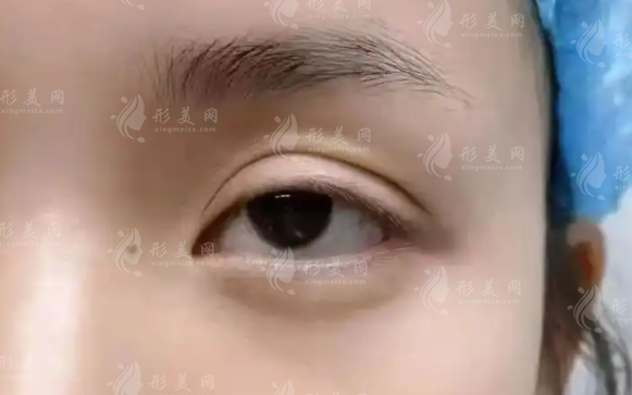 鄭小紅眼修復(fù)1.3萬起貴嗎?看完技術(shù)細(xì)節(jié)再判斷!