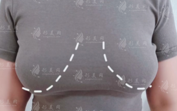 李建東維維胸下垂提升靠譜嗎？真實技術(shù)揭秘