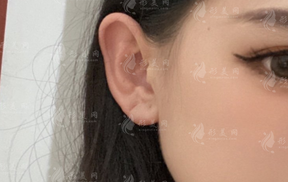 埋線精靈耳能維持多久?揭秘真實(shí)保持時(shí)間