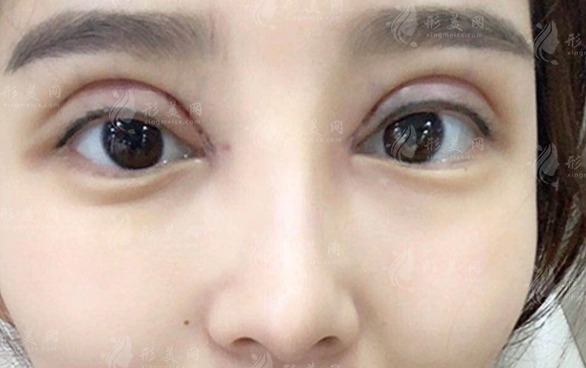 雙眼皮修復醫(yī)生排名前十：國內(nèi)眼修復口碑專家技術(shù)解析