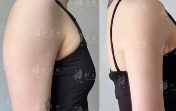 優(yōu)脂塑吸脂效果怎么樣？超聲乳化技術(shù)，出血少+恢復(fù)快+能雕馬甲線