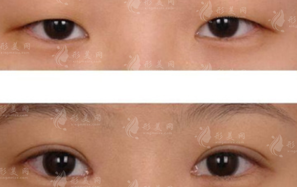 北京美萊上瞼下垂矯正好嗎?技術(shù)+價格全解析